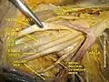 Ulnar nerve