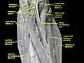 Femoral nerve.Deep dissection.