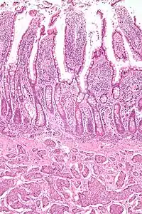 Micrograph of a small intestine neuroendocrine tumour. H&E stain.