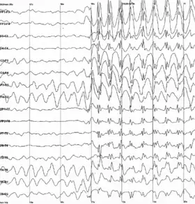 Graph showing 16 voltage traces going across the page from left to right, each showing a different signal. At the middle of the page all of the traces abruptly begin to show sharp jerky spikes, which continue to the end of the plot.