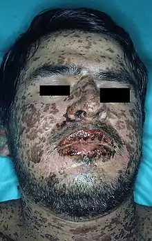 Censor bars applied to a patient with Stevens–Johnson syndrome