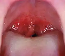 Mouth wide open showing the throatNote the petechiae, or small red spots, on the soft palate. This is an uncommon but highly specific finding in streptococcal pharyngitis.