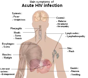 A diagram of a human torso labelled with the most common symptoms of an acute HIV infection