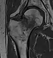 T1-weighted turbo spin echo MRI confirms a fracture, as the surrounding bone marrow has low signal from edema.