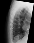 Confluent ossification of multiple contiguous vertebral bodies in diffuse idiopathic skeletal hyperostosis (DISH)