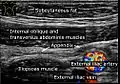Ultrasound of a normal appendix for comparison