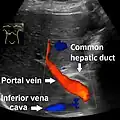 Borderline of a dilated perihilar bile duct, measuring 8 mm.