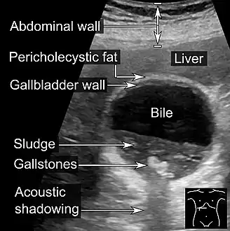 Gallstones and biliary sludge, but the gallbladder wall is not clearly thickened, with no edema in the pericholecystic fat, thus not cholecystitis.