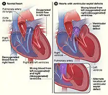 Figure A shows the structure and blood flow in the interior of a normal heart. Figure B shows two common locations for a ventricular septal defect. The defect allows oxygen-rich blood from the left ventricle to mix with oxygen-poor blood in the right ventricle.