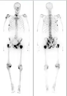 Medical image showing a man's skeleton with several dark spots along the bones.